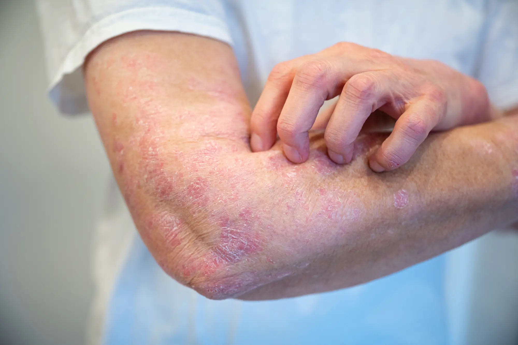 Biltmore Dermatology client with Psoriasis
